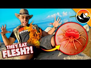 Bitten by Chiggers! Great Balls of FIRE!