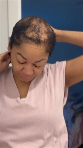 Styling My Hair With CCCA Alopecia #alopecia #hairloss #beauty #selfcare #shorts