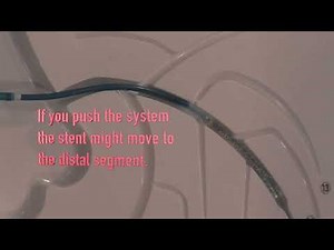 Angioplasty technique: Troubleshooting of a guide extension catheter.
