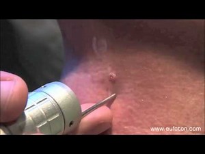 LASEmaR 500 - Dermatofibroma Removal - Rimozione Dermatofibroma