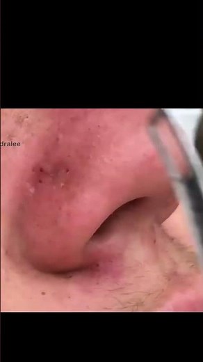 Blackhead Duel