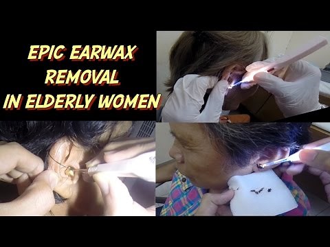 Epic Earwax Removal in Elderly Women