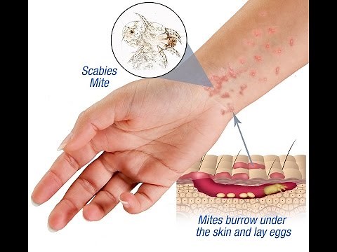 Scabies: Causes, Symptoms and Treatment