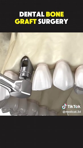 Understanding Dental Bone Graft Surgery Through 3D Animation