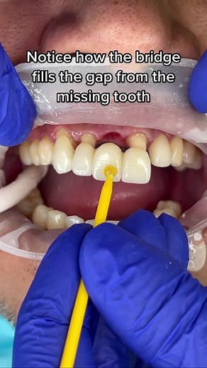 Porcelain Veneer Bridge Transformation | Before and After Dental Procedure