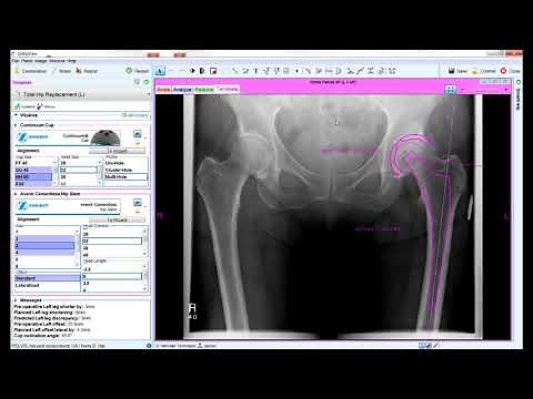 Total Hip Arthroplasty Planning| Materialise OrthoView 7.1 Tutorial