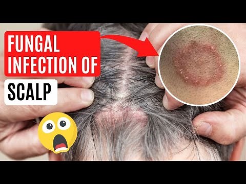 What causes Scalp Ringworm? ✅ Effective Treatment (Tinea Capitis)
