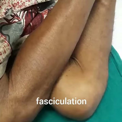 Fasciculation|Dr Bhupendra Shah |doctor sathi