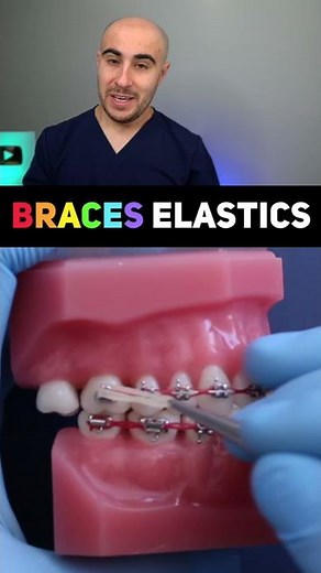 Braces Elastics Explained #shorts