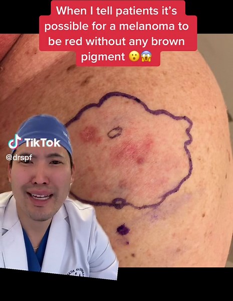 Understanding Amelanotic Melanoma: Dermatologist’s Nightmare