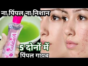 Remove even the oldest pimples, stains and any type of marks / pimple remedies
