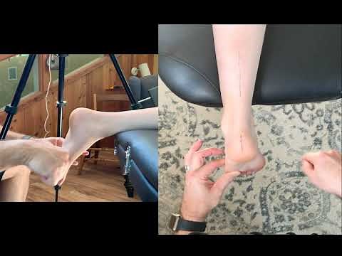 Leg, ankle, and foot alignment from subtalar neutral.