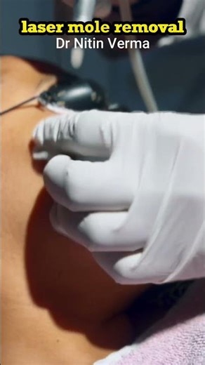 Advanced laser Mole Removal Technique | Scarless Mole Removal 4
