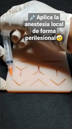 Apply local anesthesia this way if you want to suture small wounds.