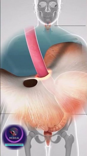 Inside the Body: How a Hiatal Hernia Begins
