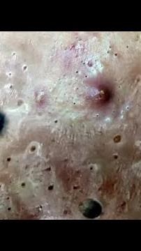 Extreme Blackhead Removal at Nasa Spa | Relax Every Day With Sac Dep Spa 2023 #9755