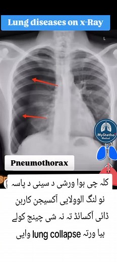 Understanding Pneumothorax: Causes, Symptoms, and Treatments