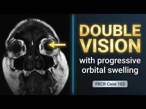 Diplopia In A 35-Year-Old Male | Rapid Review Case 103