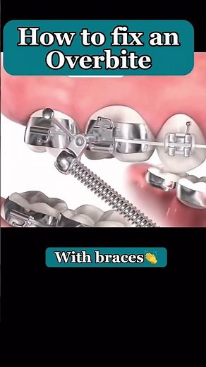 Overbite Correction #shorts