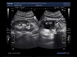 Ultrasound Video showing renal Angiomyolipoma with stones at P.U.J.