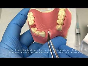 Ridge preservation; Bio-Oss Collagen with Mucograft Seal