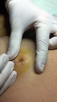 Sebaceous Cyst Extraction