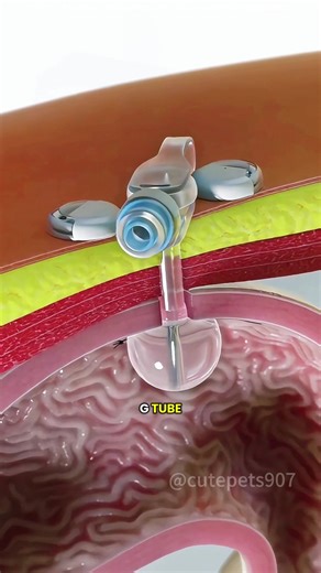 Percutaneous Endoscopic Gastrostomy (PEG) #gastrostomy #gastrostomytube #gastrostomyfeeding #gastrostomytubeadministration #percutaneousendoscopicgastrostomy #medical3danimation #3dmedicalanimation #bariatricsurgery