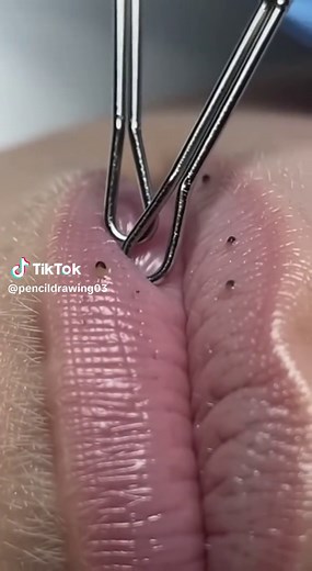Effective Blackhead Removal Techniques for Lips