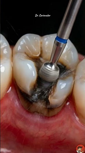 Molar Restoration Step-by-Step: Sculpting Perfect Anatomy ✨