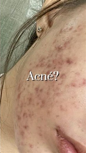 El mejor tónico para pieles grasa y con tendencia acneica 🍵 #aesthetic #skincaretips #kbeauty