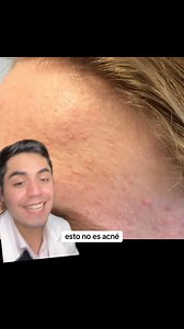 1.3M views · 180K reactions | Esto no es #acne acne fungico #skincare #piel #skincare | Doctor Gabriel Aedo Dermatólogo | Facebook