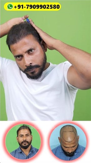 HAIR TRANSPLANT: GAME CHANGER 😁#hairstyle#shorts #haircare #hairtransplant#haircut #hairgrowth#LIKE