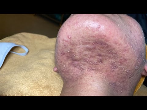 Acne Treatment For "Hung" (P12) | Điều Trị Mụn Cho Hùng (P12) - SacDepSpa#210