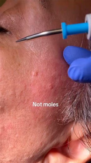 Dr. Azadeh Shirazi on Instagram: "Have you noticed these skin colored bumps on your face? They’re enlarged oil gland growths called sebaceous hyperplasia. Aka “Wisdom Spots” They’re commonly seen on the forehead or cheeks as small yellow bumps. When you look at them close up you see a central pit with little lobules around it. The good news is we can remove them! Accutane shrinks them and it’s a form of medical therapy. Call your #Dermatologist if they bother. And if they don’t scroll on #sebace
