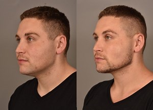 My Buccal Fat Removal and Neck Liposuction Before-and-After: What the Experience Was Like and Whether My Results Were Worth It