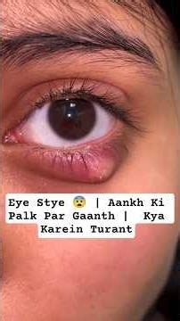Eye Stye 😨 | Aankh Ki Palk Par Gaanth | Kya Karein Turant
