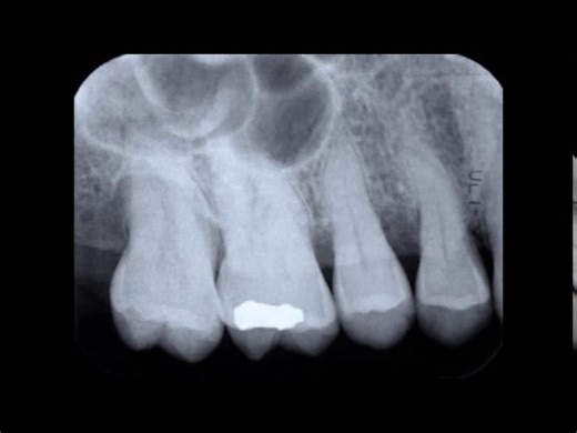 Dental Tutorial - Paralleling Technique & Dental X-Rays