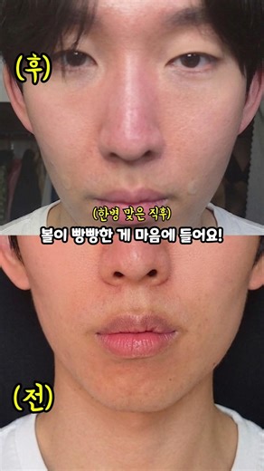 I got the Juve Look Volume that's a surefire fix for sunken cheeks. #JuveLookVolume
