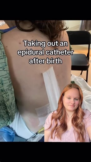 Natal Bliss Birth Doula on Instagram: "Taking out an epidural (most viewed video in 2025)"