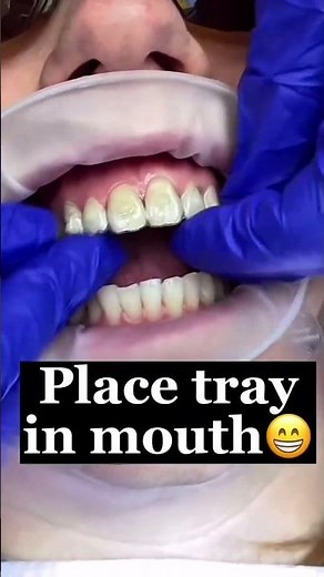 How to install invisalign attachments?