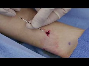 StimRouter - Placement of an Implantable Tibial Nerve Stimulator Step by Step Instructions