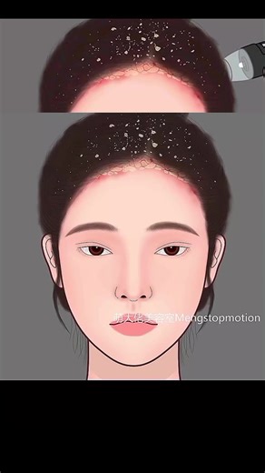 ASMR Itchy scalp and head acne Stress-relieving scalp treatmant #asmr #relaxing #treatment #satisfying #relaxation