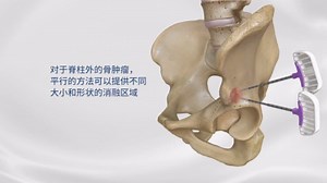 OsteoCool骨转移瘤射频消融