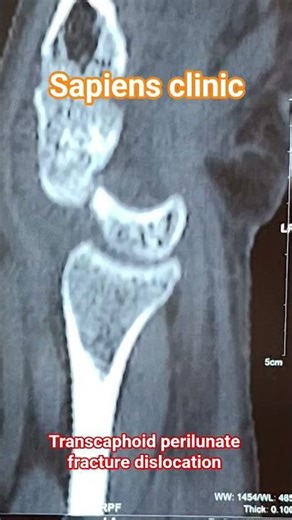Transcaphoid perilunate fractional dislocation