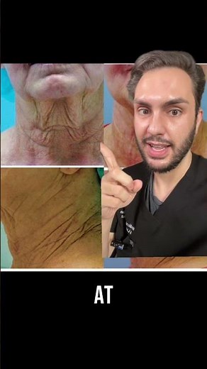 Phenol Peel Before and After Acne Scars, Saggy Skin, Fine Lines and Wrinkles | MaximumSkin