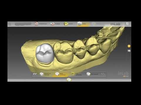 The Ultimate Guide: How to Create a Ceramic Restoration in 10 minutes using InLab Cadcam Software.