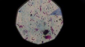 Tuberculosis, syphilis cases on the rise in Montreal