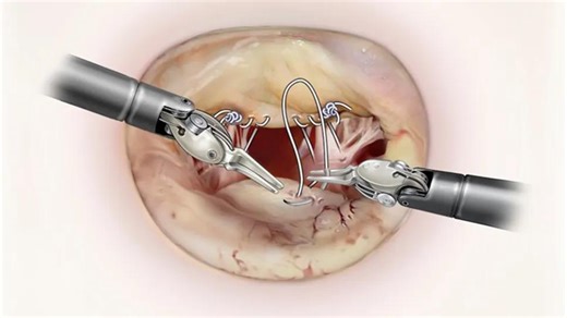 Robotically Assisted Mitral Valve Repair: As Experience Deepens, Patient Applications Grow