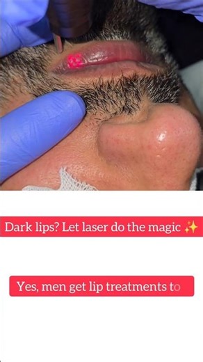 Lip Lightening Treatment for Men | Real Procedure