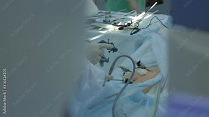 Sterile operating room, patient lies on operating table, with help of punctures in abdominal cavity doctor introduced two manipulators, endoscopic operation, tumor removal, medicine, new technologies